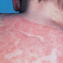 eczema