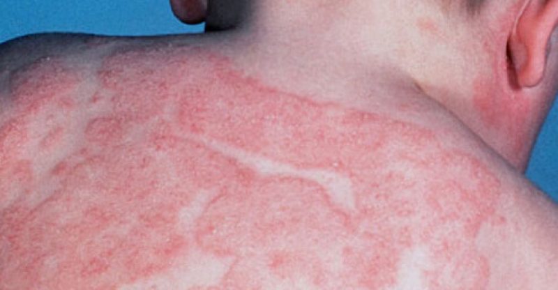 eczema